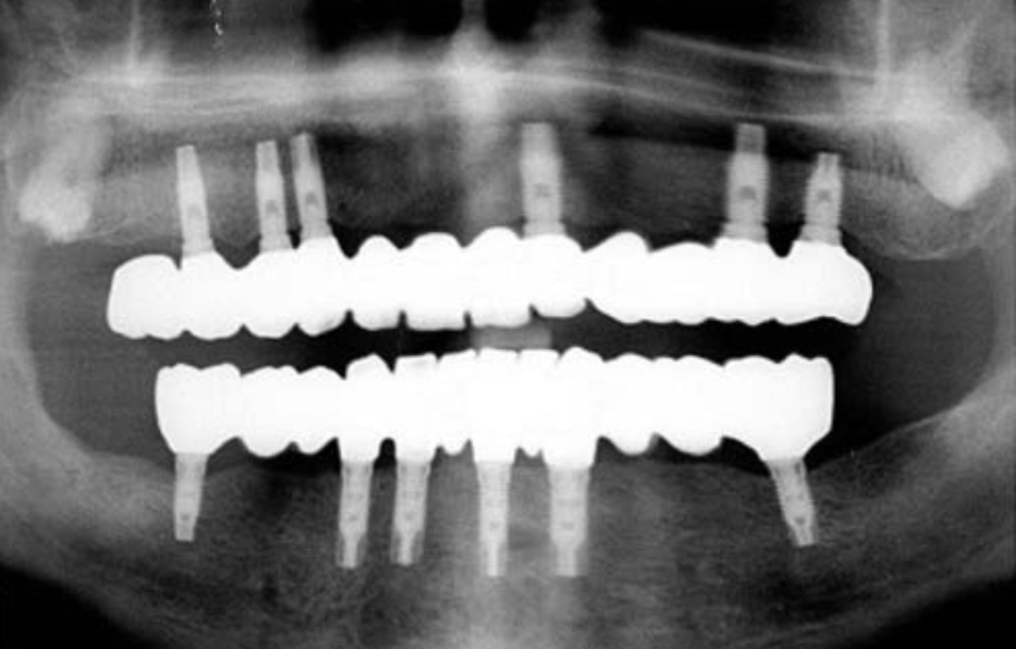 Panoramic dental X-ray showing implant-supported dental restorations